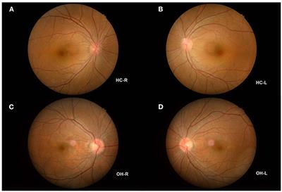 Characteristics of the Fractional Amplitude of Low-Frequency Fluctuation in Ocular Hypertension Patients: A Resting-State fMRI Study